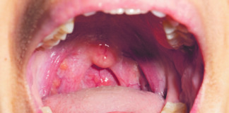 Whooping cough cases recorded in region
